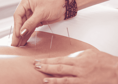 Akupunktur